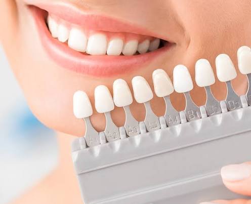 Bleaching Gigi Nine Dental